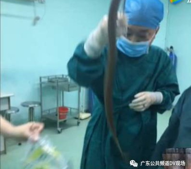 Trung Quốc: Tới bệnh viện với quả cà tím trong trực tràng, người đàn ông khai để chữa táo bón theo mẹo dân gian - Ảnh 3.