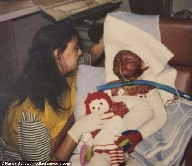 2 tuổi đã bị bỏng toàn thân vì máy giặt phát nổ, hơn 20 năm sau ai cũng bất ngờ khi nhìn thấy dáng vẻ của người phụ nữ ấy - Ảnh 1.
