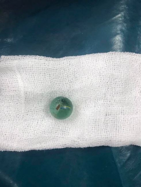 Cứu sống b&eacute; g&aacute;i 6 tuổi nuốt vi&ecirc;n bi v&agrave;o kh&iacute; quản - Ảnh 2.