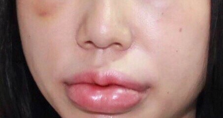  Cô gái trẻ bị biến dạng mắt, môi sau khi tiêm filler tại một thẩm mỹ viện ở Hà Nội  - Ảnh 1.