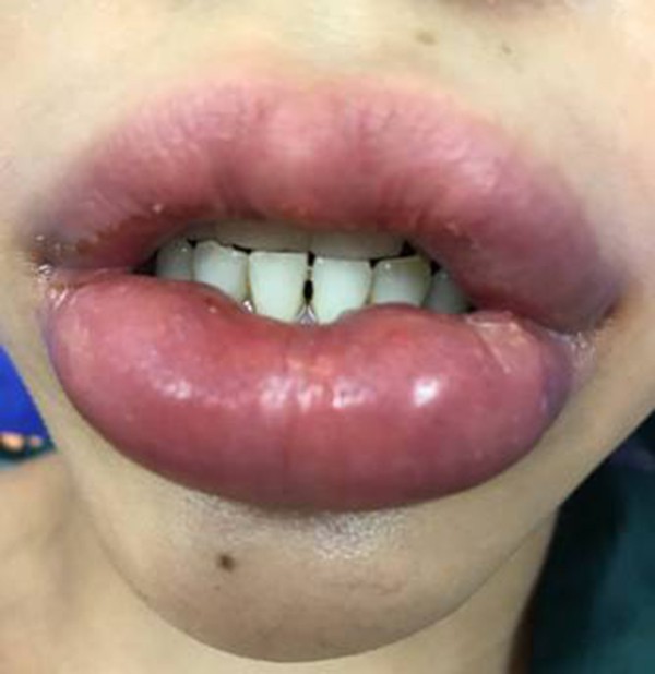  Cô gái trẻ bị biến dạng mắt, môi sau khi tiêm filler tại một thẩm mỹ viện ở Hà Nội  - Ảnh 3.