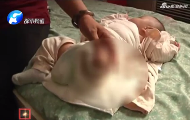 Trung Quốc: Nữ y tá quên tắt máy sấy tóc, bé sơ sinh 4 ngày tuổi bị bỏng nặng, phải cưa chân - Ảnh 3.