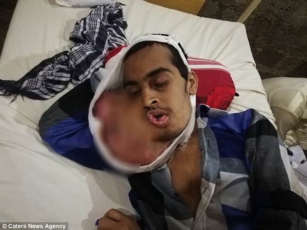 Pakistan: Chàng trai 21 tuổi mắc bệnh ung thư miệng sau khi đi nhổ răng khôn giá rẻ ở phòng khám kém uy tín - Ảnh 3.