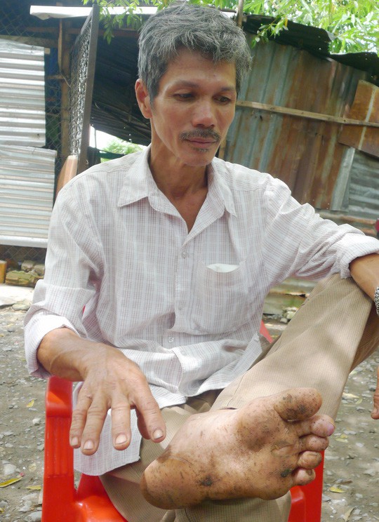 Thầy giáo đi lạc trong rừng ở Phú Quốc: Bàn chân có dấu hiệu nhiễm trùng - Ảnh 2.