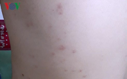 Du khách tắm biển Đà Nẵng bị ngứa ngáy, nổi mẩn đỏ khắp người - Ảnh 3.