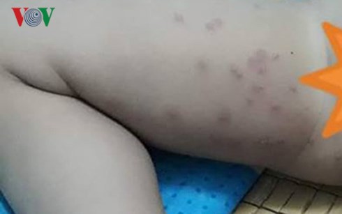Du khách tắm biển Đà Nẵng bị ngứa ngáy, nổi mẩn đỏ khắp người - Ảnh 4.