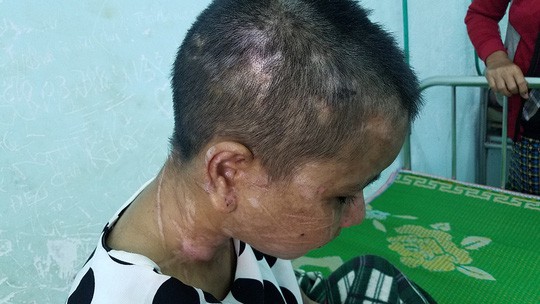 Vụ c&ocirc; g&aacute;i bị tra tấn d&atilde; man như thời trung cổ:  Y Nhi&ecirc;u được b&aacute;c sĩ Chi&ecirc;m Quốc Th&aacute;i t&agrave;i trợ phẫu thuật miễn ph&iacute; - Ảnh 1.