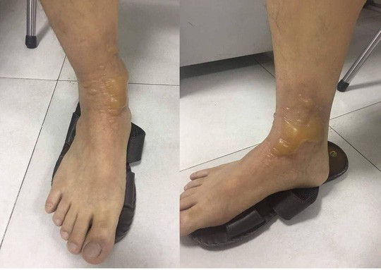 Đi massage ch&acirc;n, một nam giới nhập viện v&igrave; bỏng phức tạp - Ảnh 1.