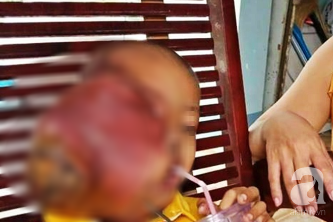 Bé trai 6 tuổi ở Tây Ninh mang khối u ác tính to khủng khiếp trên mặt vì cha dẫn đi đắp lá thuốc trôi nổi - Ảnh 2.