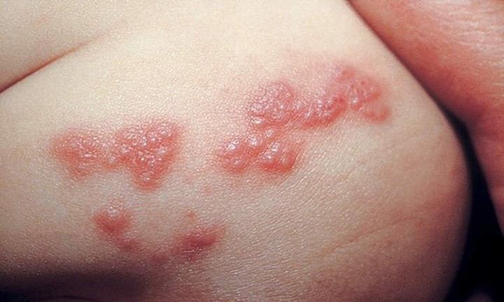 Các triệu chứng Herpes ở phụ nữ không nên bỏ qua - Ảnh 1. Các triệu chứng Herpes ở phụ nữ không nên bỏ qua - Ảnh 1.
