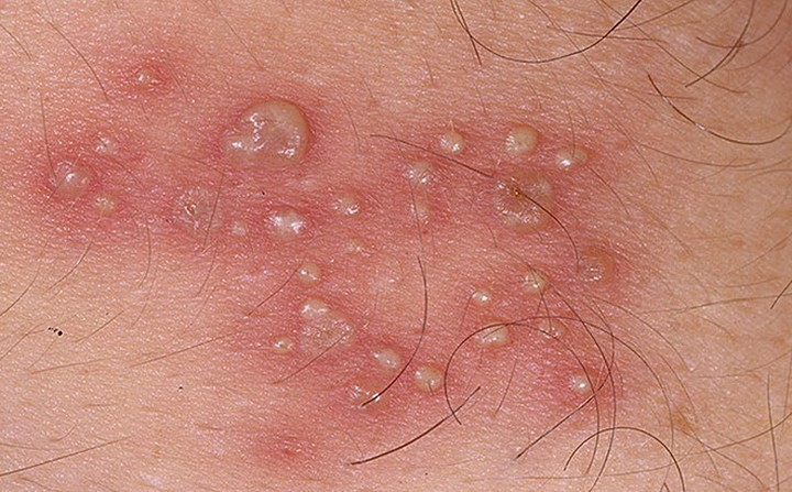 Các triệu chứng Herpes ở phụ nữ không nên bỏ qua - Ảnh 4. Các triệu chứng Herpes ở phụ nữ không nên bỏ qua - Ảnh 4.
