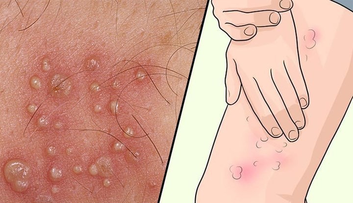 Các triệu chứng Herpes ở phụ nữ không nên bỏ qua - Ảnh 8. Các triệu chứng Herpes ở phụ nữ không nên bỏ qua - Ảnh 8.
