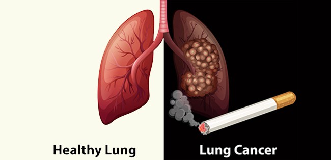 Có 20.000 người Việt Nam mắc ung thư phổi mỗi năm, nên làm gì để phát hiện sớm căn bệnh này? - Ảnh 1.