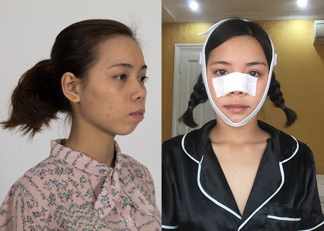 3 cô nàng đập mặt đi xây lại” gây bão MXH: Nhờ những phương pháp dao kéo này mà nhan sắc “một bước lên hương” - Ảnh 5.