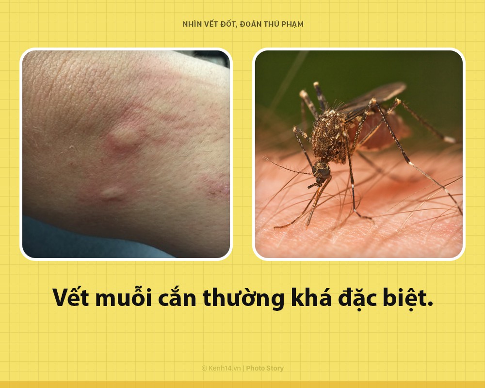 Đọc luôn để nắm được cách soi vết cắn, biết ngay con gì đốt - Ảnh 1. Đọc luôn để nắm được cách soi vết cắn, biết ngay con gì đốt - Ảnh 1.