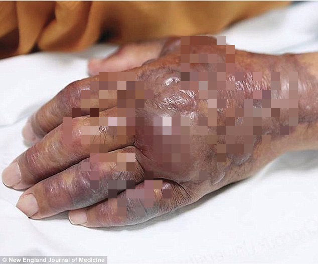 Hàn Quốc: Người đàn ông 71 tuổi phải cưa bỏ cánh tay sưng phồng, biến dạng sau khi ăn sushi không đảm bảo - Ảnh 2.