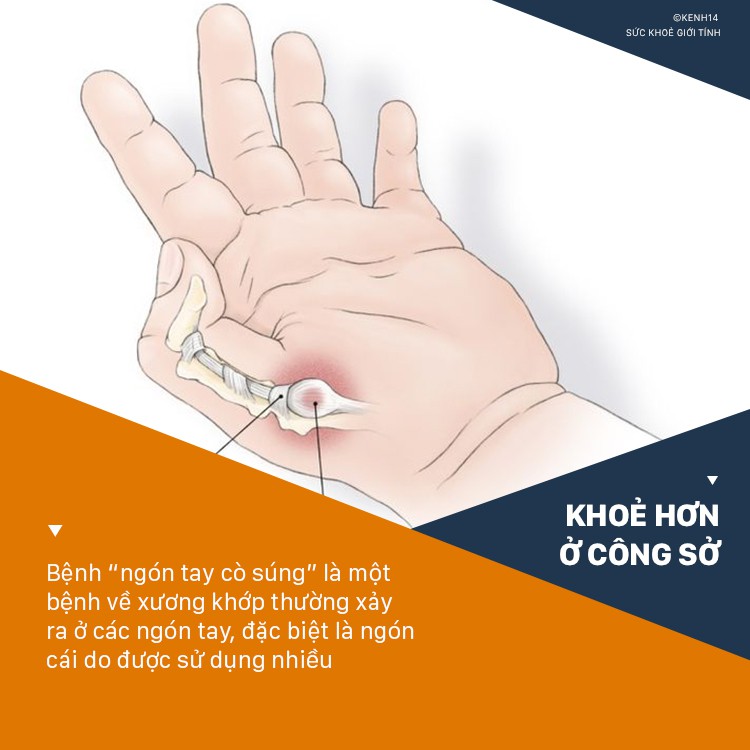 Dân văn phòng làm việc với máy tính nhiều sẽ có nguy cơ cao phải đối mặt với 4 căn bệnh ở tay sau đây - Ảnh 7.