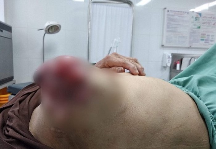 Đắp lá chữa u vú suốt 3 năm, người phụ nữ gánh hậu quả đau lòng - Ảnh 1. Đắp lá chữa u vú suốt 3 năm, người phụ nữ gánh hậu quả đau lòng - Ảnh 1.
