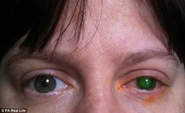 Người phụ nữ 39 tuổi suýt bị mù mắt chỉ vì đi bơi quên bỏ kính áp tròng ra khỏi mắt - Ảnh 2.