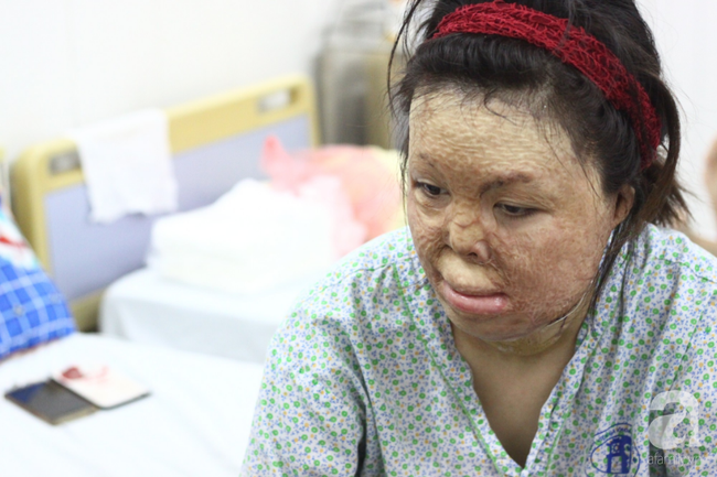 Sau 1 năm và hàng chục cuộc phẫu thuật, người vợ Hà Nội bị chồng thiêu hôm mùng 2 Tết, chỉ có 1% cơ hội sống sót đã hồi sinh - Ảnh 1.