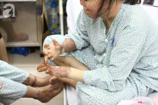 Sau 1 năm và hàng chục cuộc phẫu thuật, người vợ Hà Nội bị chồng thiêu hôm mùng 2 Tết, chỉ có 1% cơ hội sống sót đã hồi sinh - Ảnh 8.