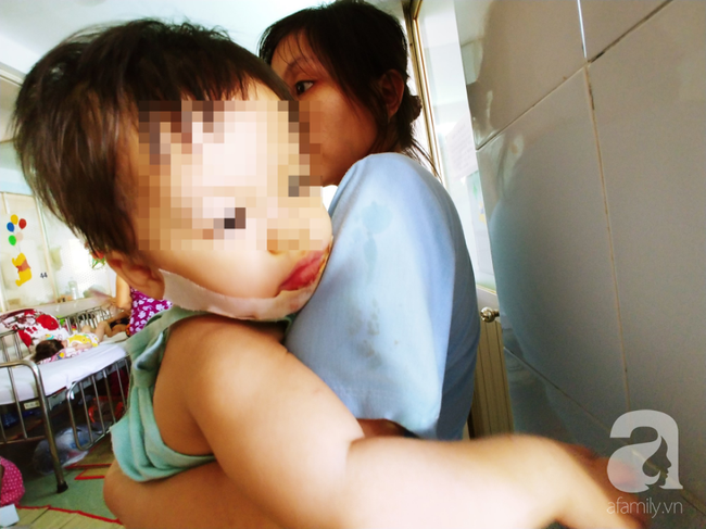 TP.HCM: Mẹ đơn thân tố bảo mẫu làm con gái 18 tháng tuổi bị bỏng nặng ở mặt - Ảnh 1.