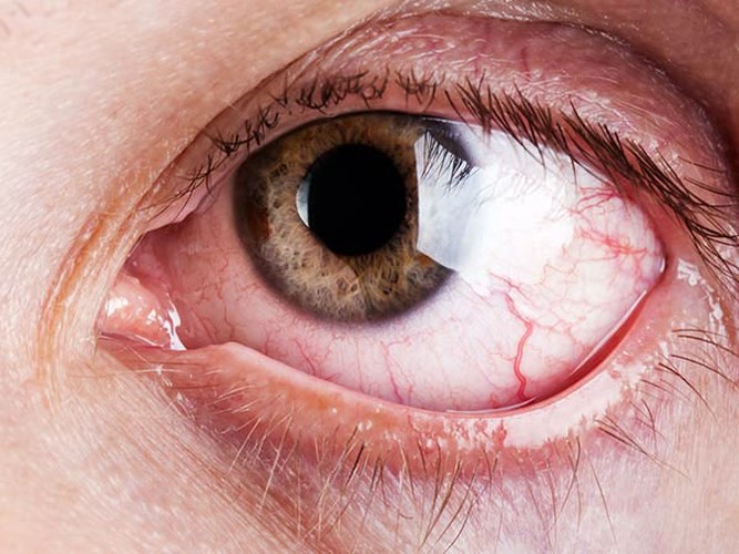 7 lý do gây nên tình trạng chảy nước mắt không thể tự kiềm chế - Ảnh 7. 7 lý do gây nên tình trạng chảy nước mắt không thể tự kiềm chế - Ảnh 7.