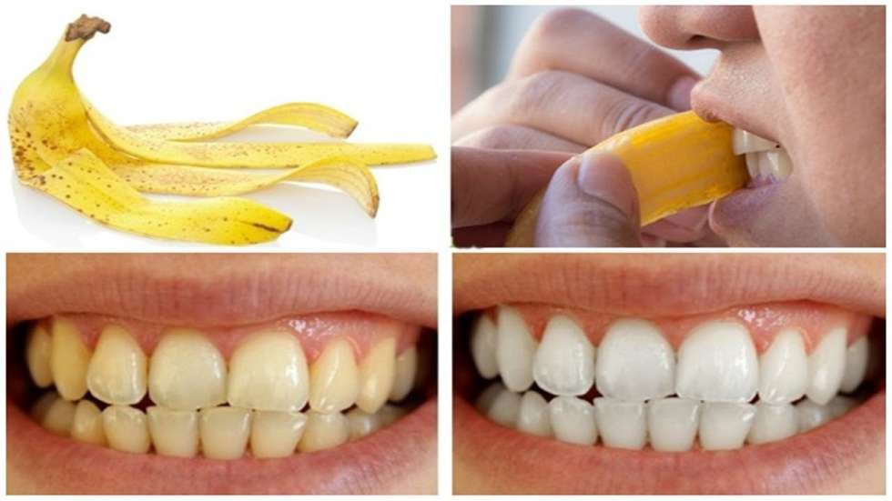 Cách làm trắng răng hiệu quả với vỏ chuối - Ảnh 3.