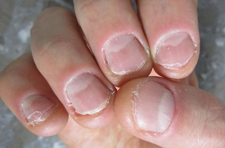 Đâu chỉ mỗi gây hại cho móng, cắn móng tay thường xuyên còn khiến bạn gặp phải hàng loạt vấn đề sức khỏe tai hại khác - Ảnh 2. Đâu chỉ mỗi gây hại cho móng, cắn móng tay thường xuyên còn khiến bạn gặp phải hàng loạt vấn đề sức khỏe tai hại khác - Ảnh 2.