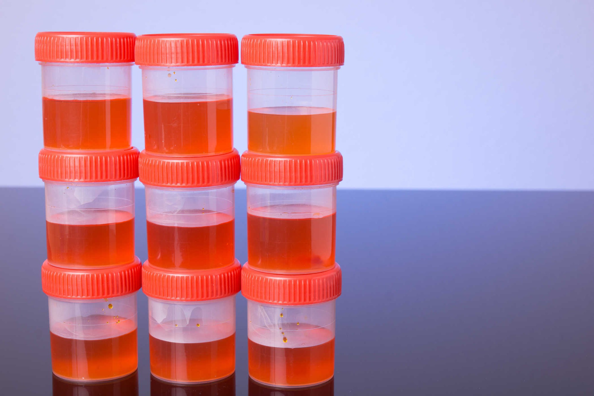 Tưởng là những dấu hiệu vô hại nhưng hóa ra lại ngầm cảnh báo bệnh ung thư bàng quang - Ảnh 5. Tưởng là những dấu hiệu vô hại nhưng hóa ra lại ngầm cảnh báo bệnh ung thư bàng quang - Ảnh 5.