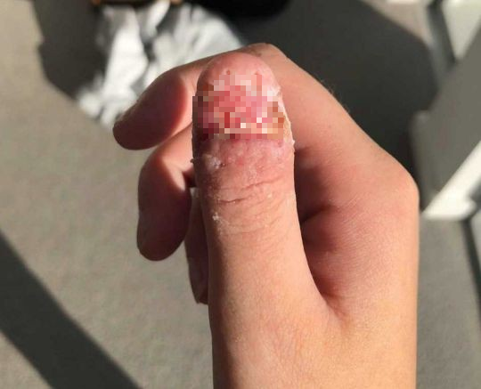 Cắn móng tay suốt 4 năm liền, cô gái trẻ gặp phải chấn thương nghiêm trọng tới mức phải cắt bỏ ngón cái - Ảnh 2.