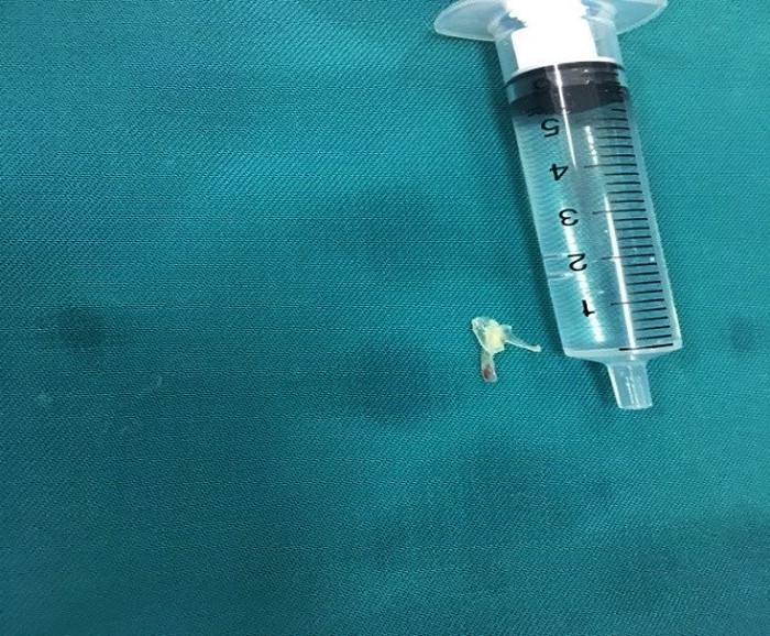 Bé trai 10 tháng tuổi ở Nghệ An hóc xương cá gần 1 cm - Ảnh 1. Bé trai 10 tháng tuổi ở Nghệ An hóc xương cá gần 1 cm - Ảnh 1.
