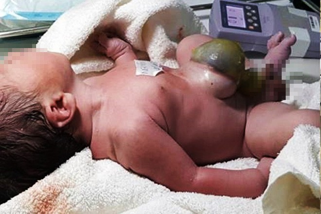 Vừa chào đời, ruột và gan bé sơ sinh 39 tuần tuổi đã lòi ra ngoài - Ảnh 1.