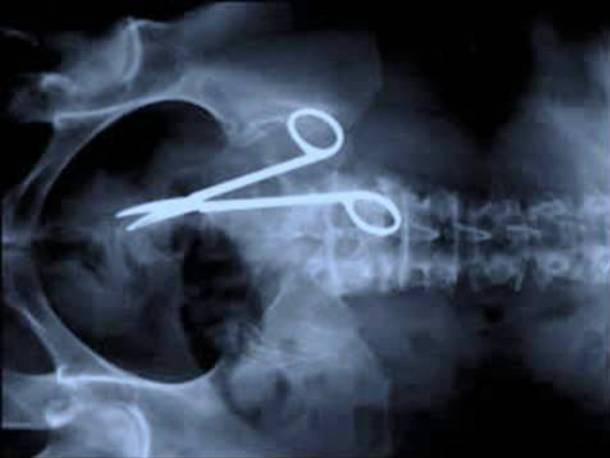 Những tấm phim chụp X-quang kinh dị nhất mà bạn từng thấy: bị mũi khoan, dao sắc hay đinh nhọn xuyên thủng hộp sọ vẫn sống sót - Ảnh 5.