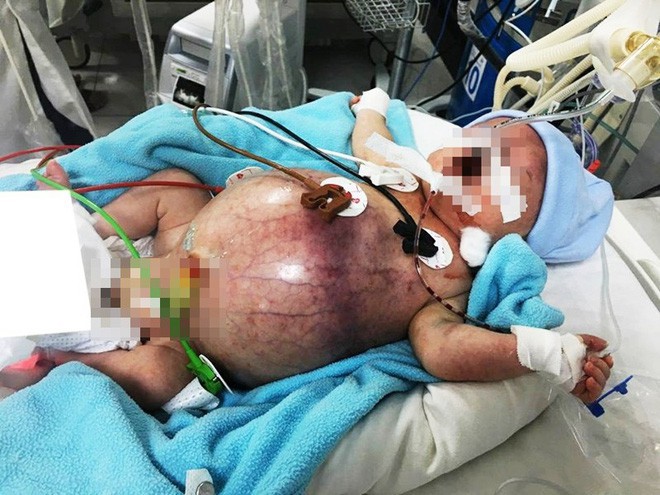 Tưởng kh&ocirc;ng thể qua khỏi, b&eacute; trai thủng ruột từ trong bụng mẹ được cứu sống kỳ diệu - Ảnh 3.