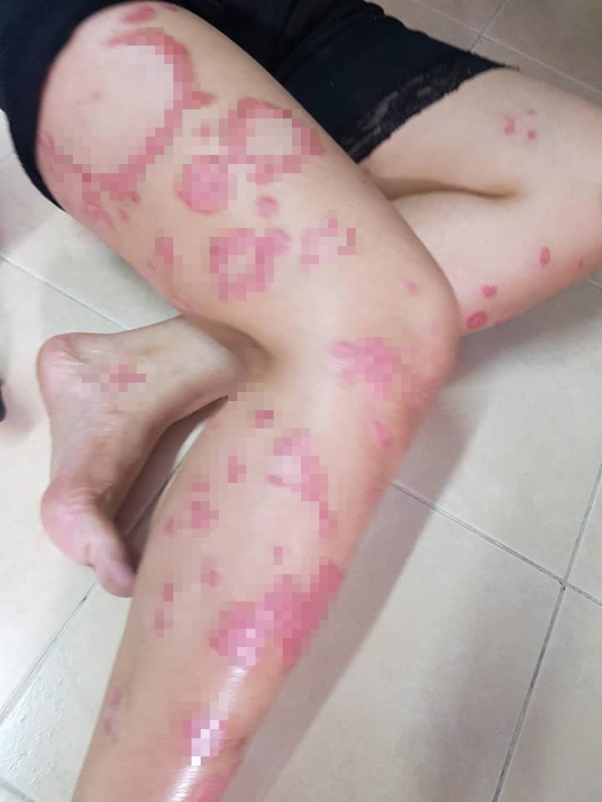 Chỉ vì mắc bệnh này mà người phụ nữ sau khi sinh không chỉ bị chồng bỏ rơi, mà còn bị sa thải - Ảnh 4.