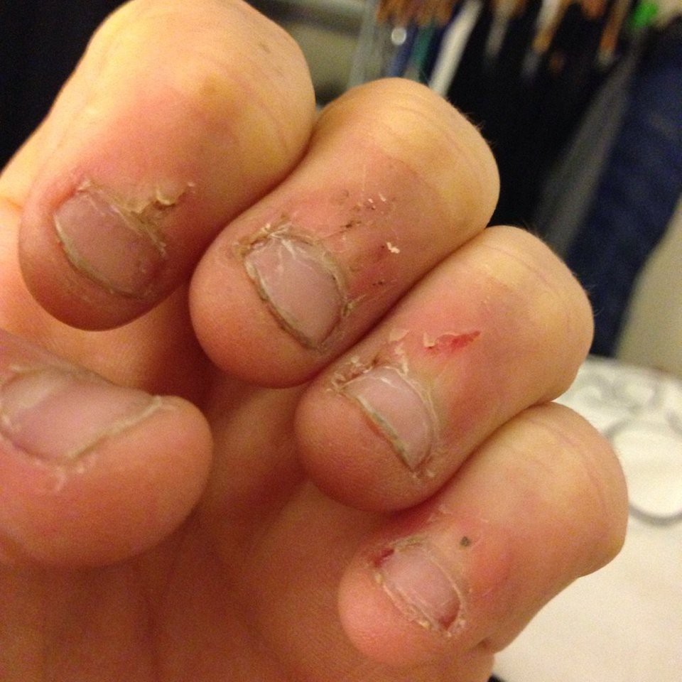 finger sore how náº», Äá» nhá»¯ng bàn chai này tháº¥y Nhìn ná»©t máu sáº¡n, rá» tay