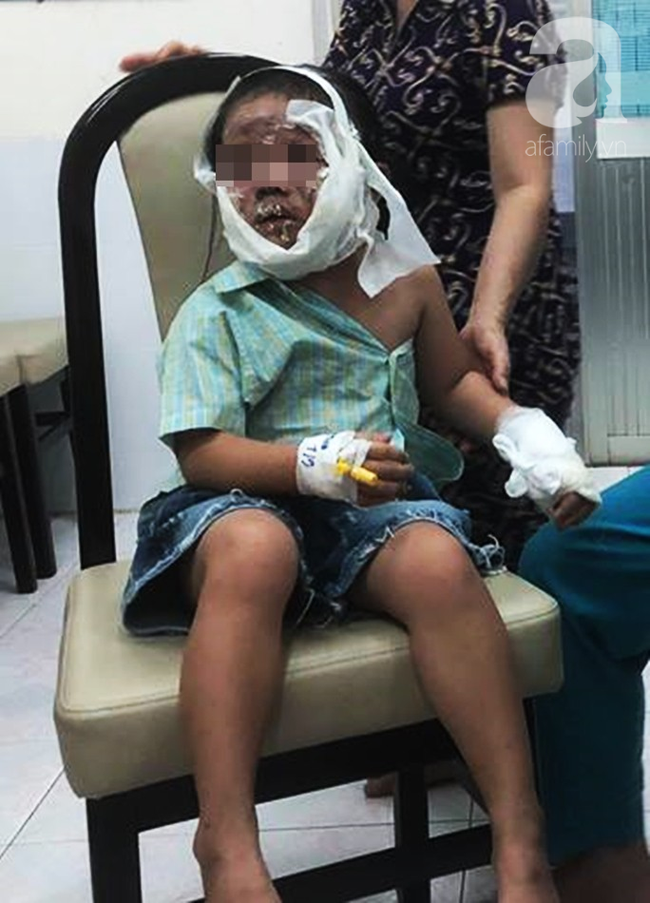 Lấy chai keo tạo kiểu t&oacute;c xịt v&agrave;o bếp than, b&eacute; g&aacute;i 6 tuổi bị lửa t&aacute;p biến dạng mặt thương t&acirc;m - Ảnh 1.