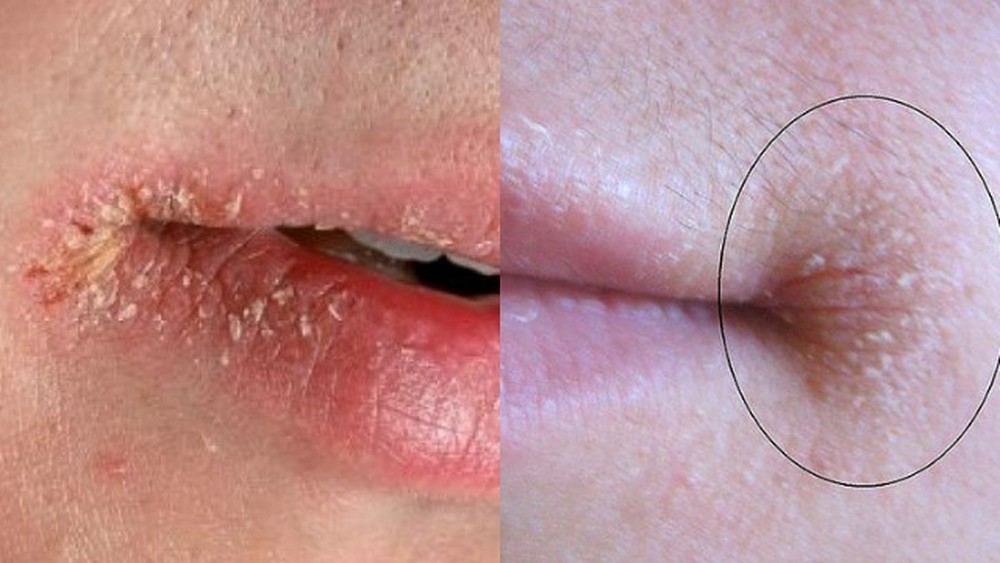 Trời n&agrave;y rất dễ bị chốc m&eacute;p nhưng mấy ai biết c&aacute;ch xử l&yacute; bệnh hiệu quả - Ảnh 1.