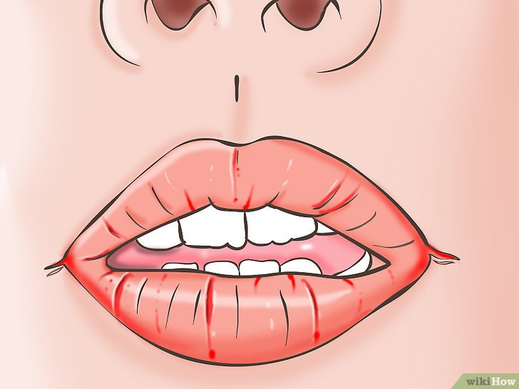 Trời n&agrave;y rất dễ bị chốc m&eacute;p nhưng mấy ai biết c&aacute;ch xử l&yacute; bệnh hiệu quả - Ảnh 2.