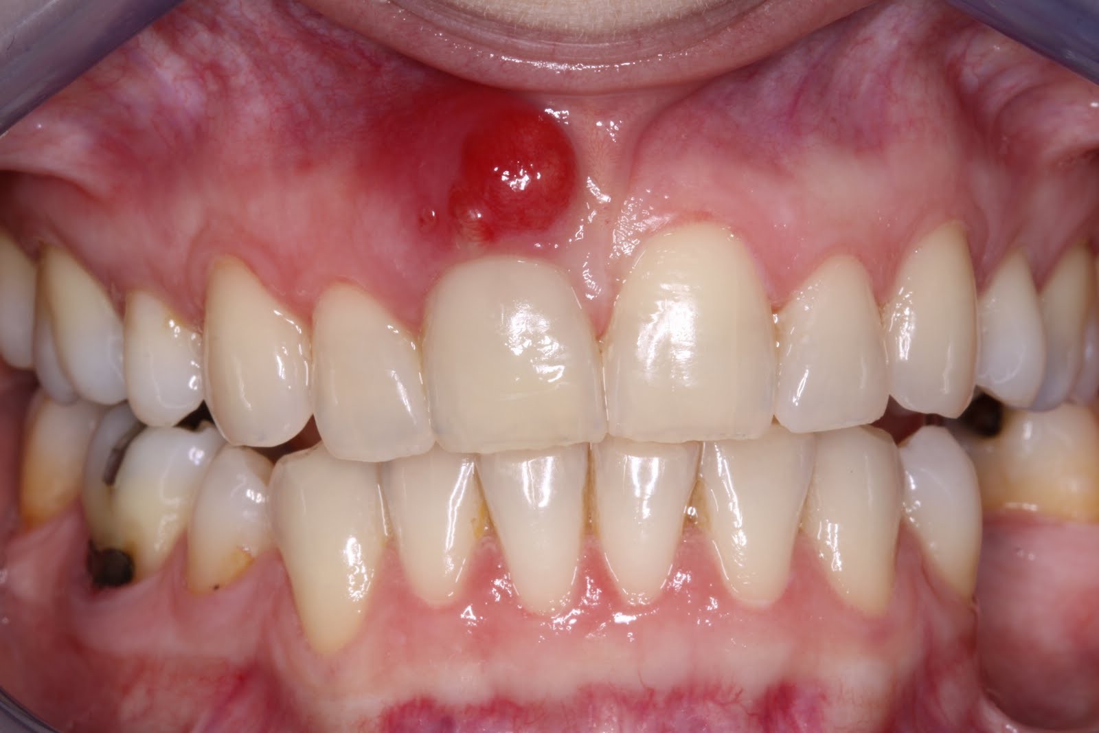 5 dấu hiệu bất thường ở vùng răng miệng có thể dự báo nhiều căn bệnh nguy hiểm mà bạn không lường trước được - Ảnh 3. 5 dấu hiệu bất thường ở vùng răng miệng có thể dự báo nhiều căn bệnh nguy hiểm mà bạn không lường trước được - Ảnh 3.