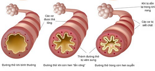 Từ triệu chứng đau thắt ngực, khó thở, cô sinh viên đã rất sốc khi biết phổi của mình trông như thế này - Ảnh 3.