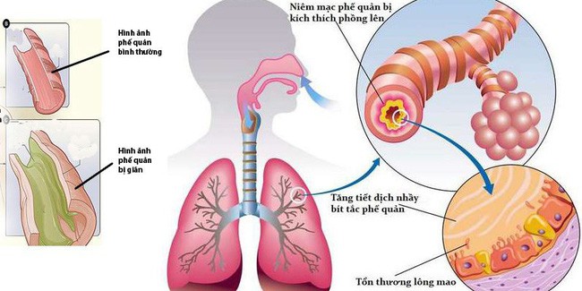 Từ triệu chứng đau thắt ngực, khó thở, cô sinh viên đã rất sốc khi biết phổi của mình trông như thế này - Ảnh 5.