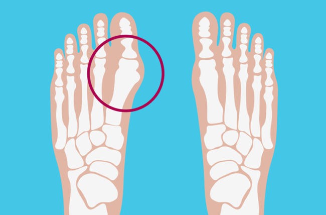 Những vấn đề thường gặp nhất ở bàn chân mà bạn không nên chủ quan coi thường - Ảnh 2.