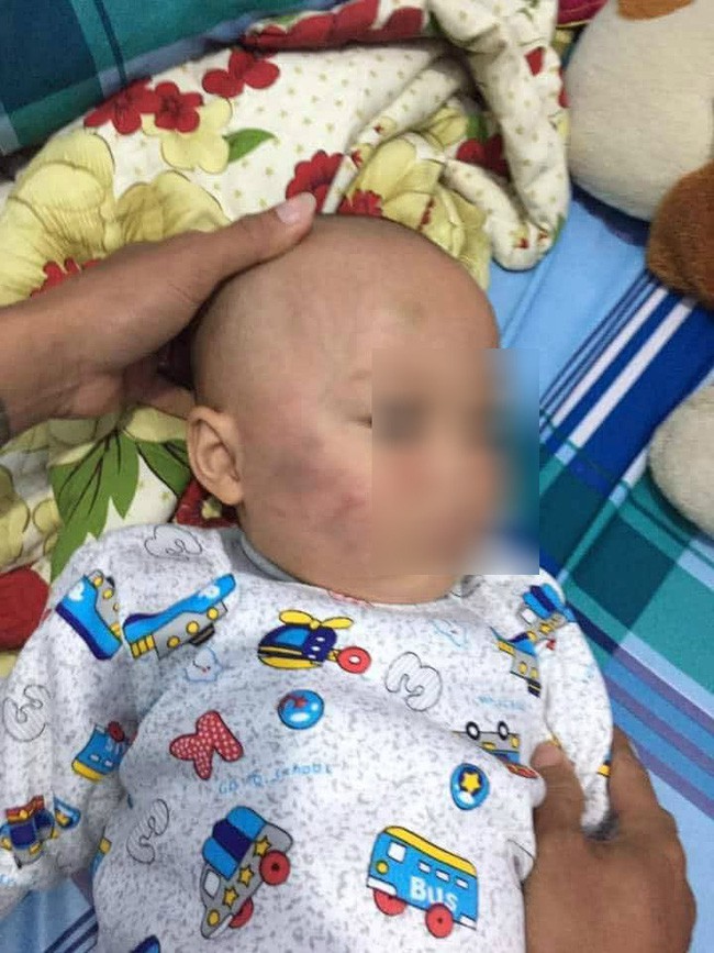 Vĩnh Long: Bé trai 19 tháng tuổi bị bảo mẫu tát liên tục vào mặt, phải nhập viện điều trị - Ảnh 1.