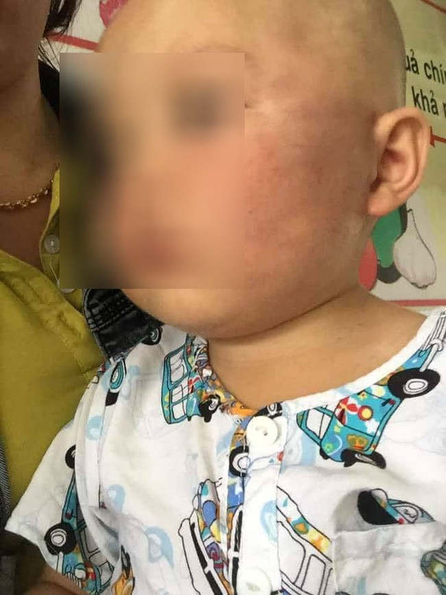 Vĩnh Long: Bé trai 19 tháng tuổi bị bảo mẫu tát liên tục vào mặt, phải nhập viện điều trị - Ảnh 2.