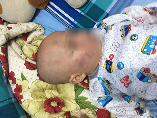 Vĩnh Long: Bé trai 19 tháng tuổi bị bảo mẫu tát liên tục vào mặt, phải nhập viện điều trị - Ảnh 4.