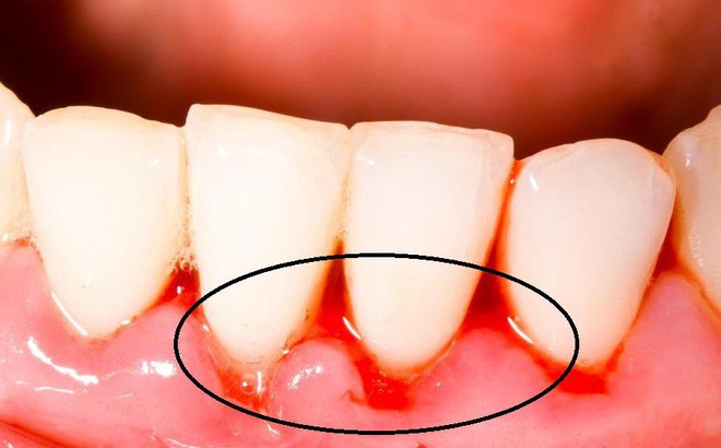 5 triệu chứng bất thường ở răng miệng cảnh báo nhiều vấn đề nguy hại mà bạn không nên chủ quan bỏ qua - Ảnh 4.