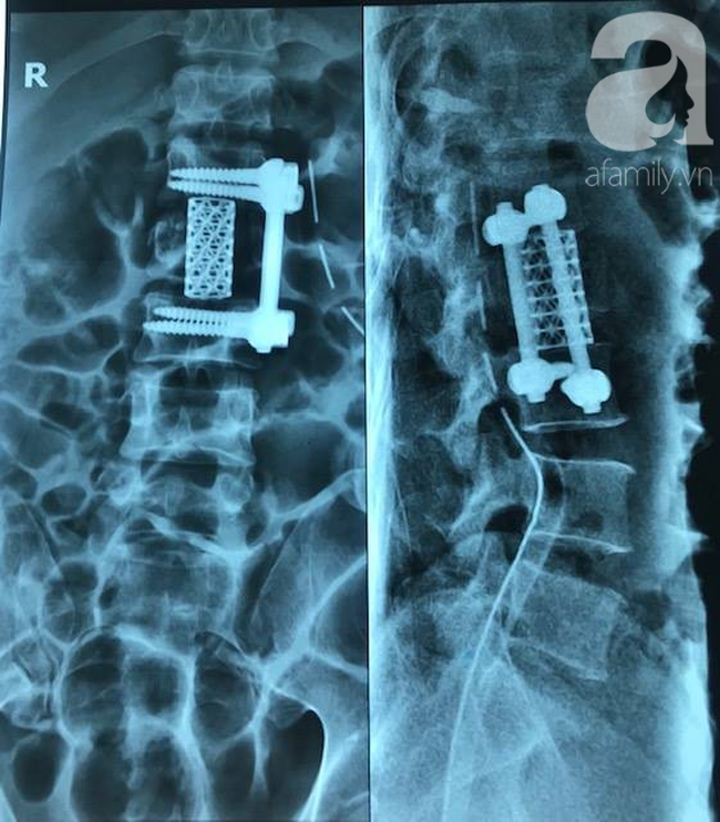 Ngã từ độ cao 8 mét xuống đất, người đàn ông bị chấn thương kinh hoàng, gãy xương từ đầu đến chân nguy kịch - Ảnh 3.