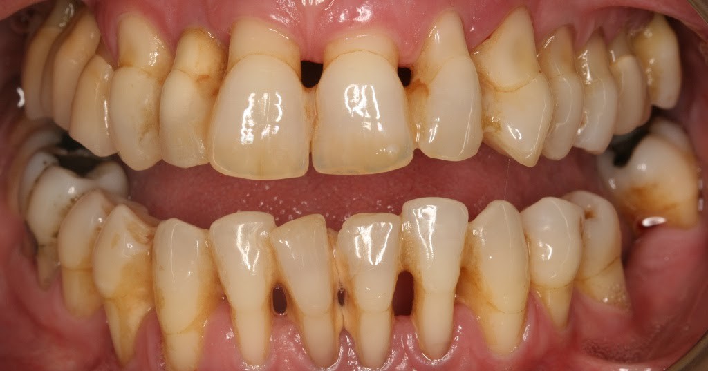 Mới 28 tuổi đã rụng răng như bà lão, cô gái Trung Quốc bất ngờ vì căn bệnh tiềm ẩn đằng sau đó - Ảnh 1. Mới 28 tuổi đã rụng răng như bà lão, cô gái Trung Quốc bất ngờ vì căn bệnh tiềm ẩn đằng sau đó - Ảnh 1.